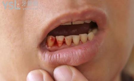 网友1382999提问牙龈出血是癌症吗为什么会牙龈出血