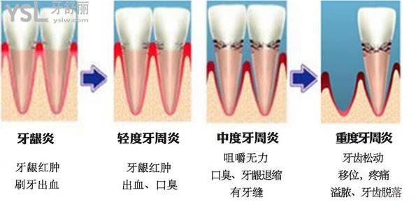 老牙松动了好疼怎么办