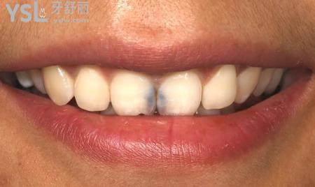 网友1388518提问门牙缝发黑是蛀牙吗可以补牙吗