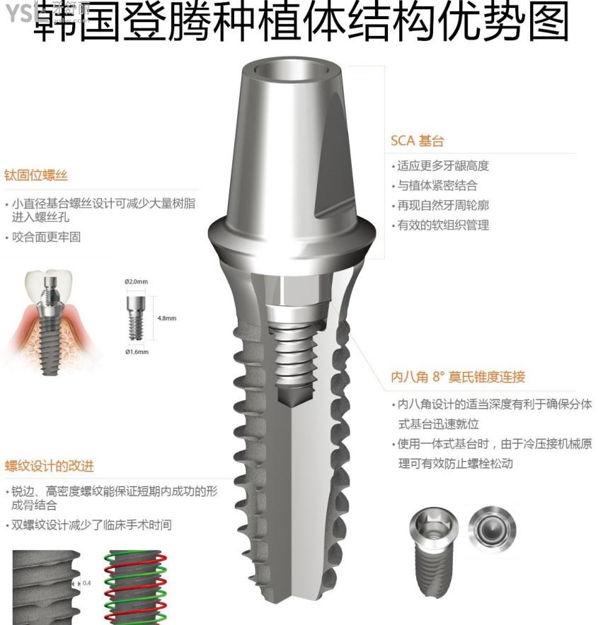 韩国种植体的基台是什么材料