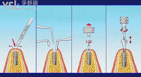 全口无牙怎么种植牙，是一颗一颗吗？