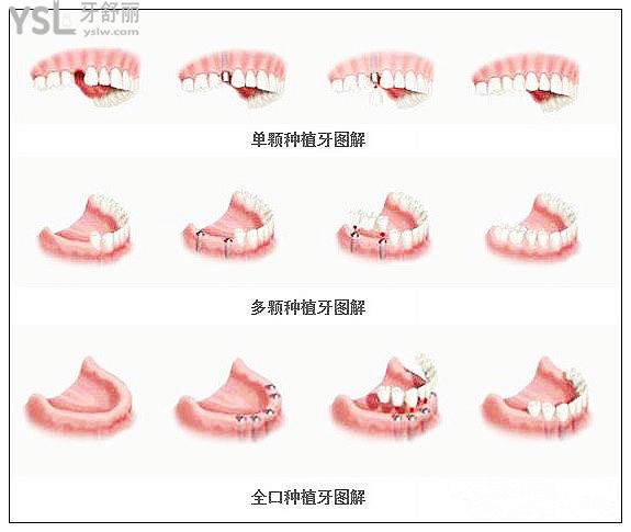 全口无牙怎么种植牙