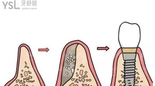 牙槽骨植骨过程图