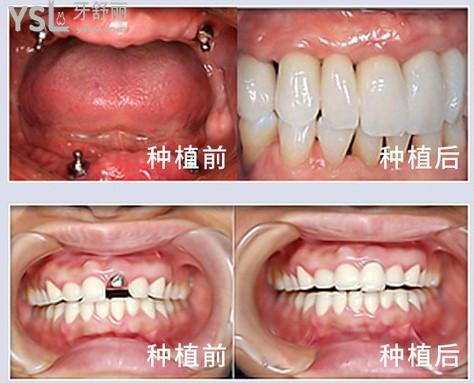 上海百仕口腔门诊部怎么样正规吗,这是当地人推荐种牙和矫正口碑好