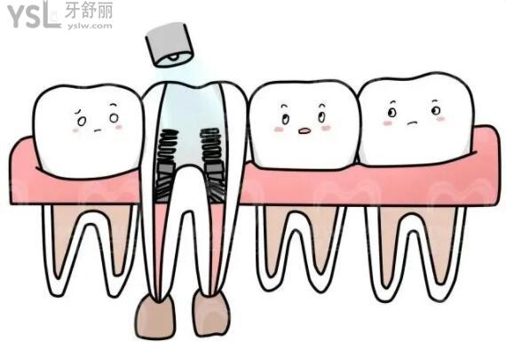 根管治疗后的牙齿配图