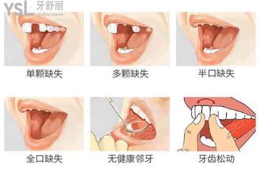 zimmer种植体价格高，它值那个价吗？.jpg