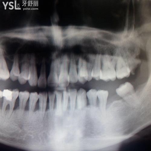 牙槽骨萎缩能不能种牙？