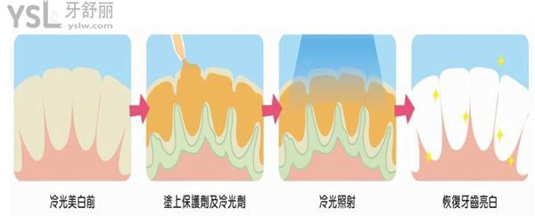 冷光美白治疗过程