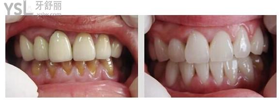 【全瓷牙和烤瓷牙術後效果圖對比】