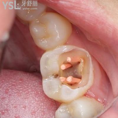 牙齿根管治疗是什么意思?