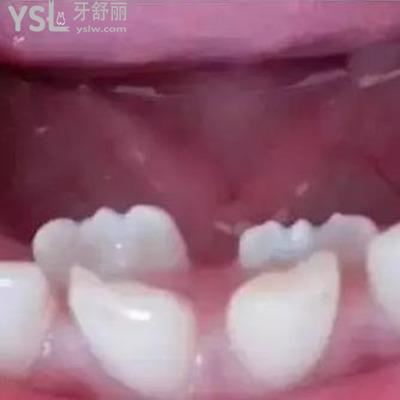 双排牙齿要拔掉吗?怎么治疗？