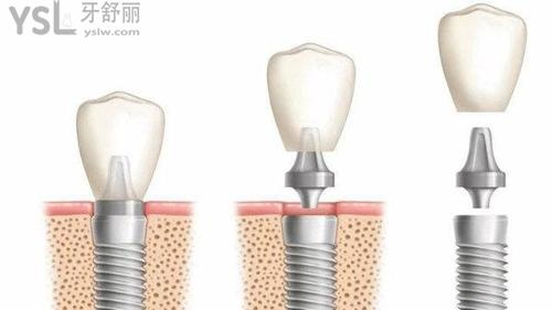 登腾与奥齿泰区别在哪里