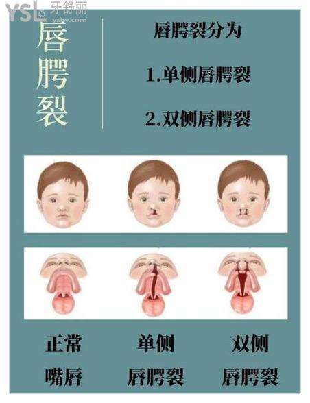 雙側唇裂手術推遲到患兒6個月後實施,具體的手術時間根據患兒健康