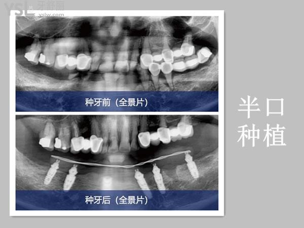 成都新桥口腔半口种植事例