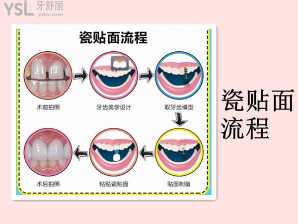 瓷贴面流程图