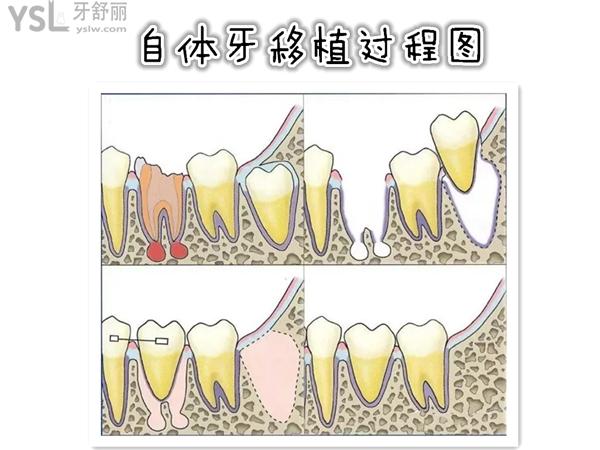 自体牙移植术过程图