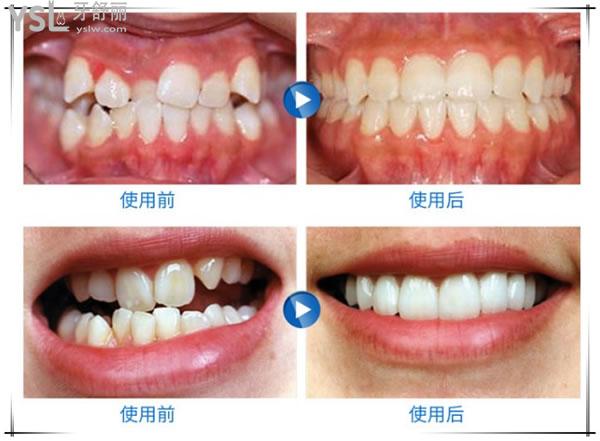 日照凯思口腔正畸病例