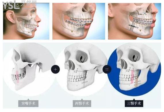 正頜手術原理骨性的牙齒畸形是沒有辦法完全依靠矯正的,需要配合正頜