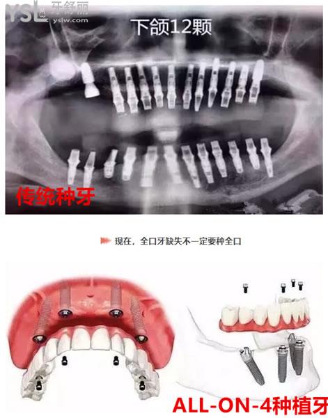 传统种牙和ALL-ON-4种植牙对比图