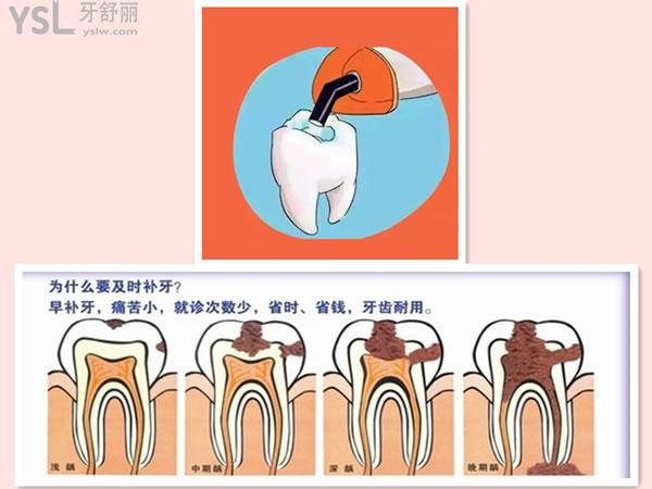 为什么要及时补牙