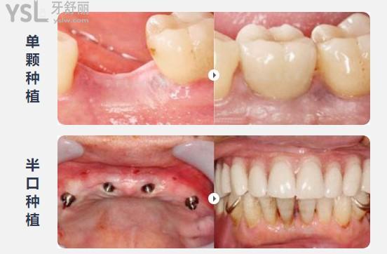盐城美奥尔口腔种植牙病例