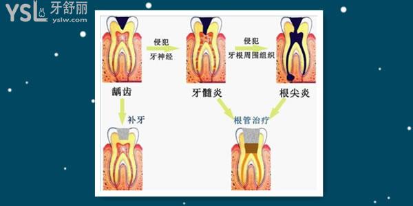 牙髓病是什么意思 牙髓炎该如何治疗呢.jpg