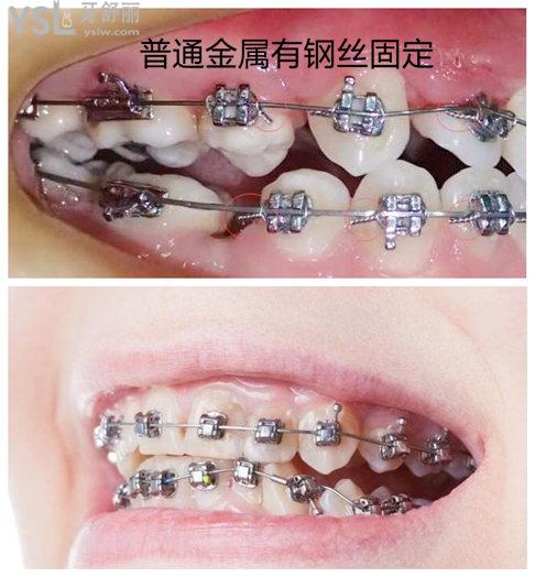 金属自锁牙套和传统牙套的区别你知道吗 自己清楚了才能不上当