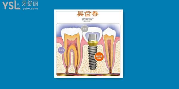 韩国奥齿泰的价位是多少 可以用几年