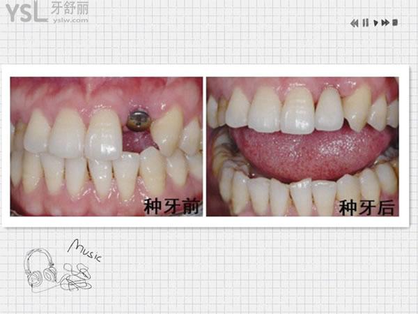 前牙种植牙一带二图片图片