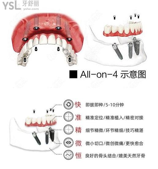 allon4半口要多少钱