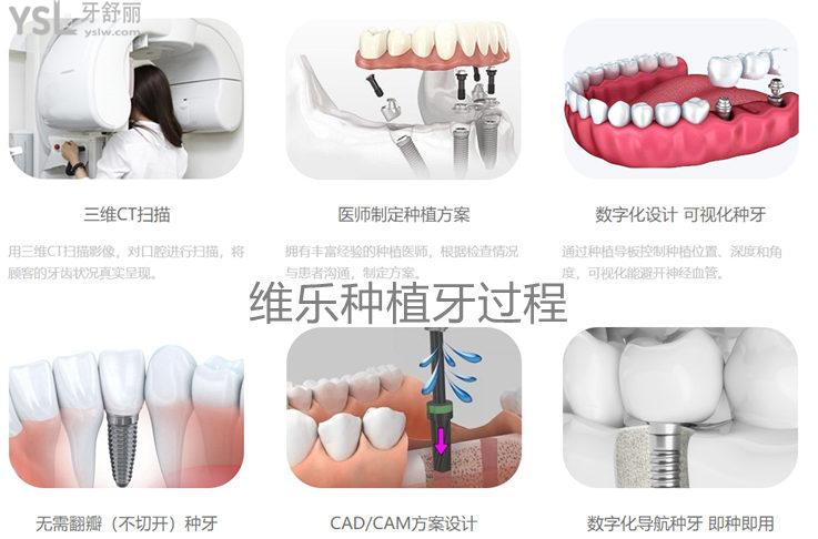 维乐口腔无锡维乐口腔种植牙价格表