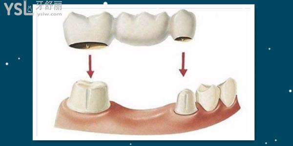牙缺失有几种修复方式图片 该如何正确选择 .jpg