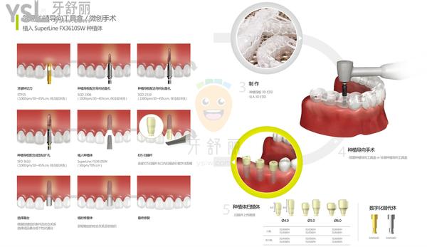 superline2种植体怎么样，superline2种植体价格多少钱