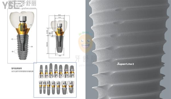 superline2种植体怎么样，superline2种植体价格多少钱