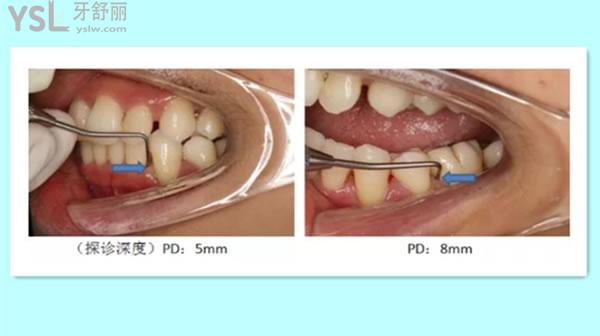 带你详细了解牙周袋深度3级分类图片