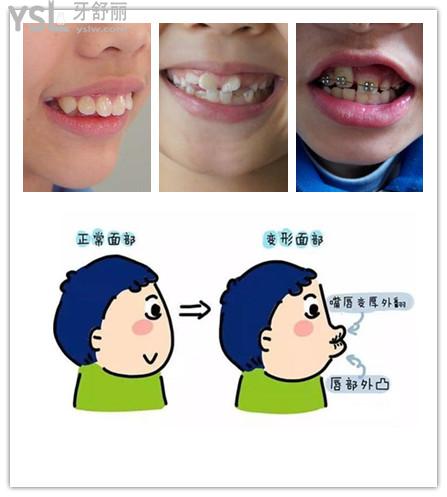科普小孩矫正牙齿需要拔牙矫正完有没有后遗症
