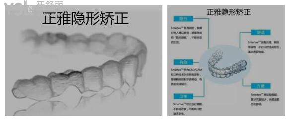 牙齿矫正隐形的什么品牌