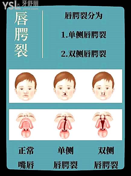 普及 唇腭裂发生在什么时期 引起唇腭裂的原因有哪些