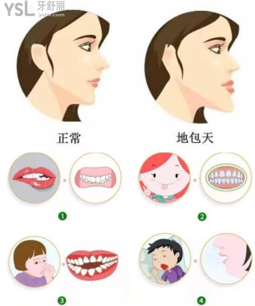 網友1382479提問地包天牙齒矯正的最佳年齡是多少歲價格多少錢誰知道