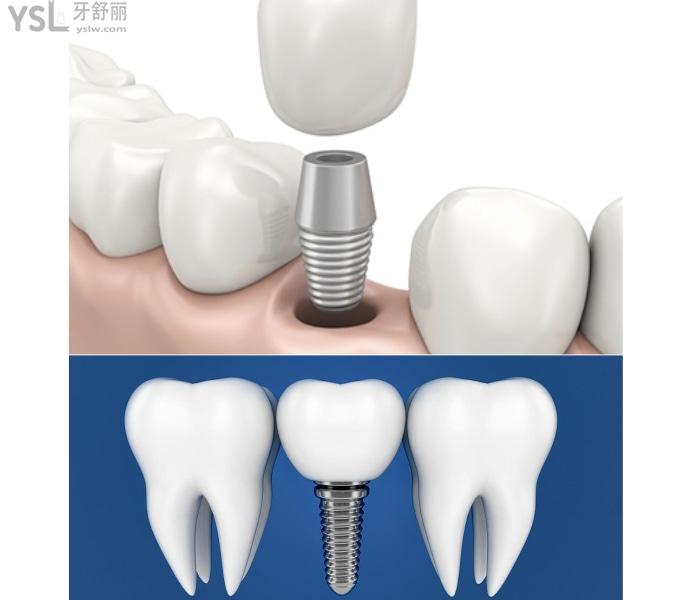 什么是种植牙齿.jpg
