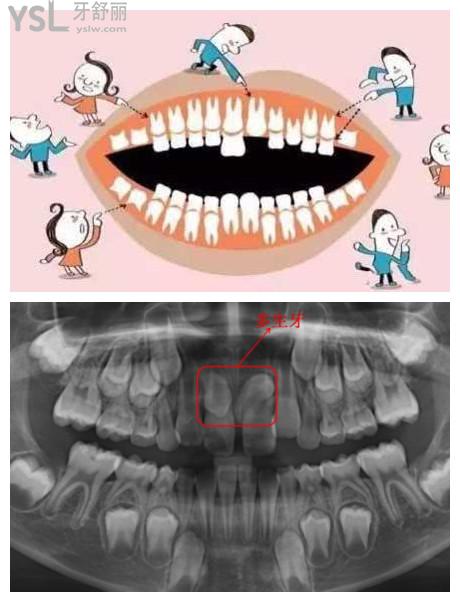 乳牙不掉恒牙萌出就会容易不齐,不利于口腔清洁.就容易得龋病.