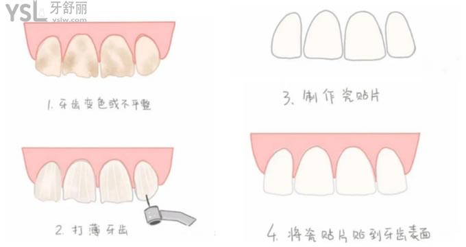 牙齿贴面制作过程