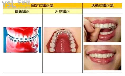 矫正器_副本.jpg