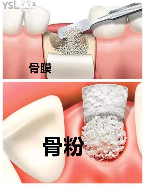 5克單骨粉骨膜:7000元左右注:因為每個人的牙齒情況不同,骨質情況也不