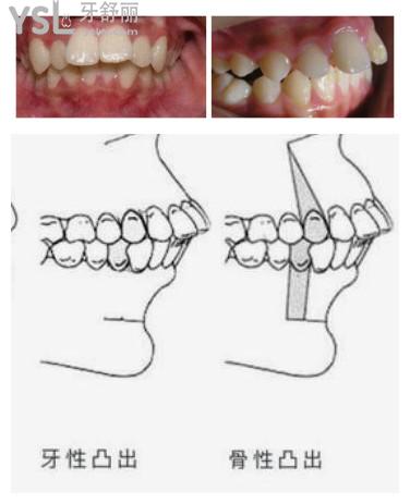 牙齿骨性前突怎么矫正图片