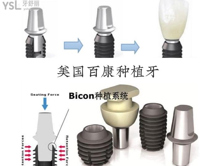 带你们深扒美国百康种植牙 看看它到底怎么样.jpg