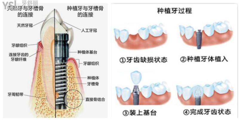 口腔医院种牙多少钱