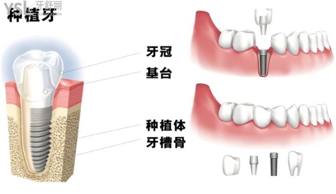 种植牙解析