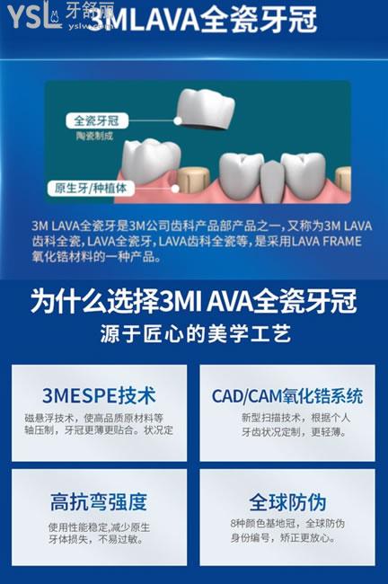 拉瓦全瓷牙是二氧化鋯全瓷牙,2001年上市,已經有百萬的患者使用修復.