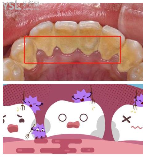 成都洗牙一般多少钱